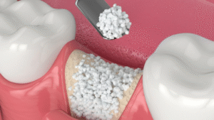 Ghép xương hàm là thủ thuật cần thiết trước khi cấy ghép một số loại Implant yêu cầu xương hàm dày