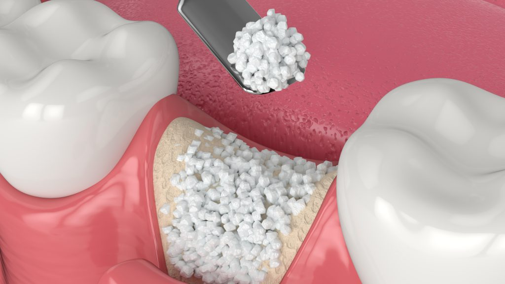 Ghép xương hàm là thủ thuật cần thiết trước khi cấy ghép một số loại Implant yêu cầu xương hàm dày